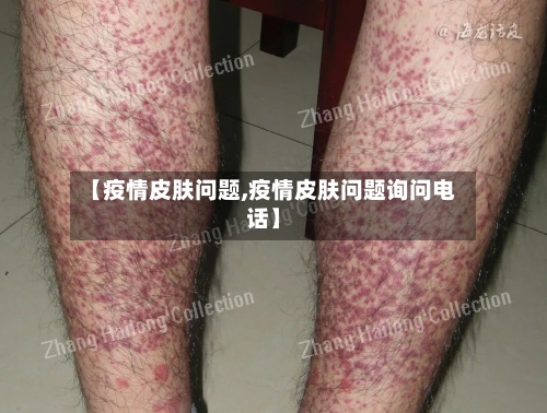 【疫情皮肤问题,疫情皮肤问题询问电话】-第2张图片