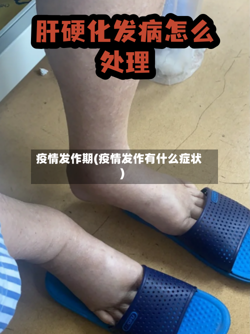 疫情发作期(疫情发作有什么症状)-第2张图片