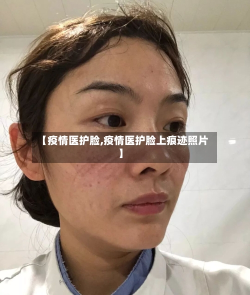 【疫情医护脸,疫情医护脸上痕迹照片】-第3张图片
